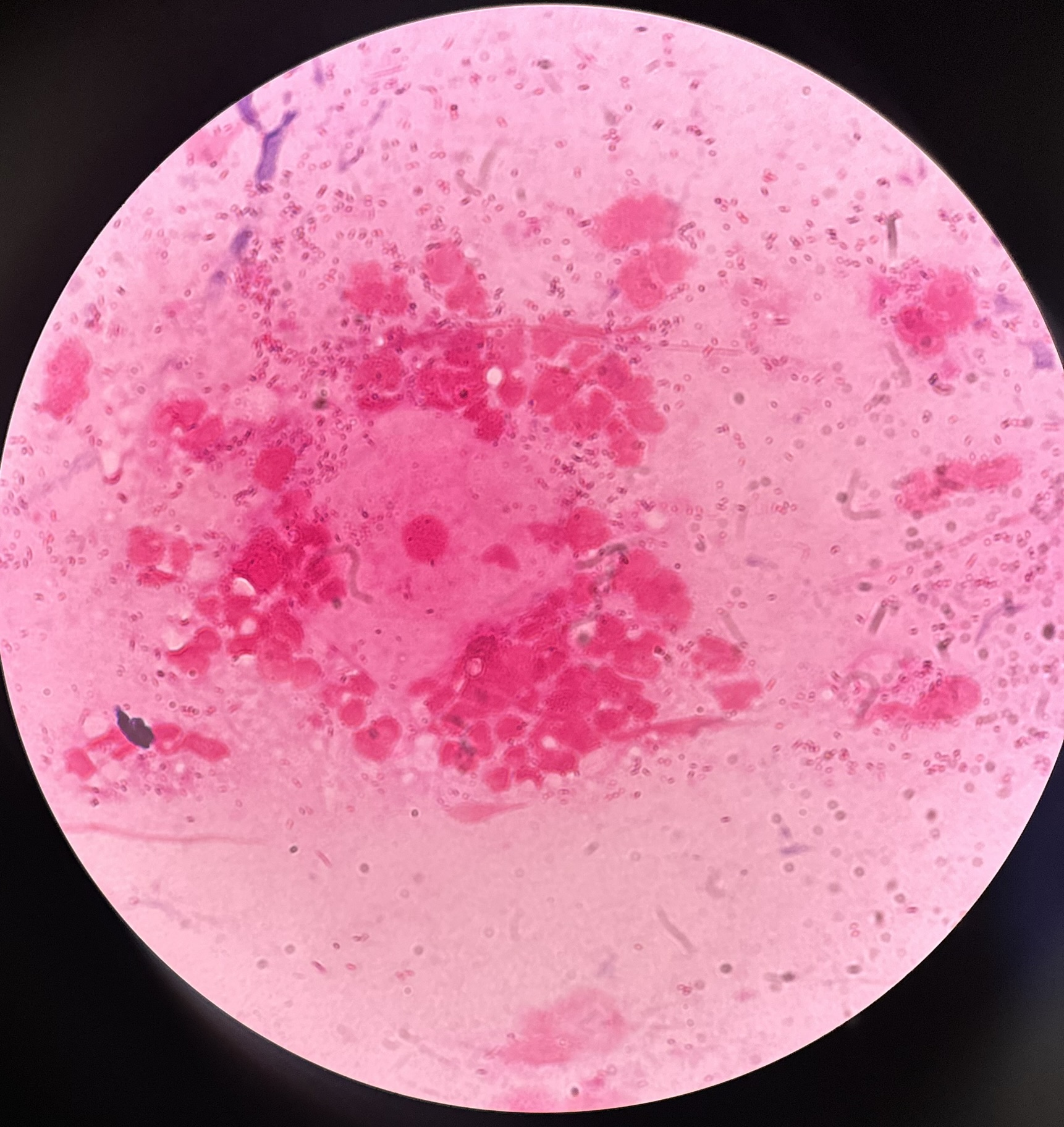 Microscopia mostrando leveduras e hifas em amostra vaginal